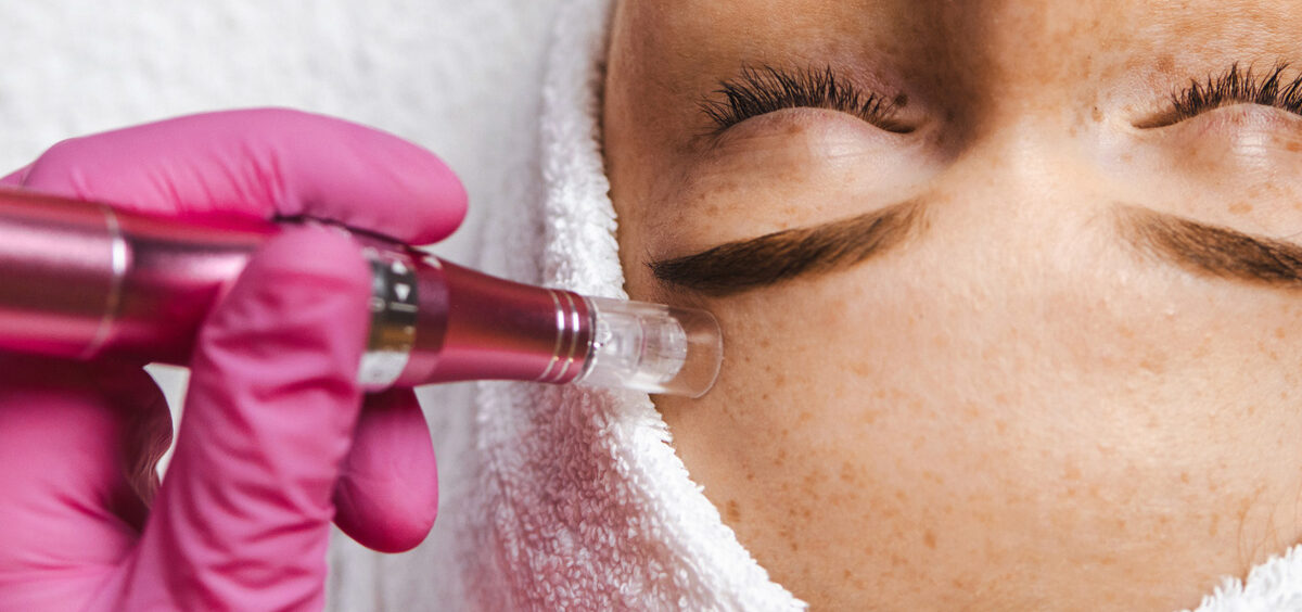 dermapen-microneedling-closeup-light-skin